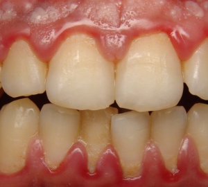 잇몸이 부었을 때 대처 방법