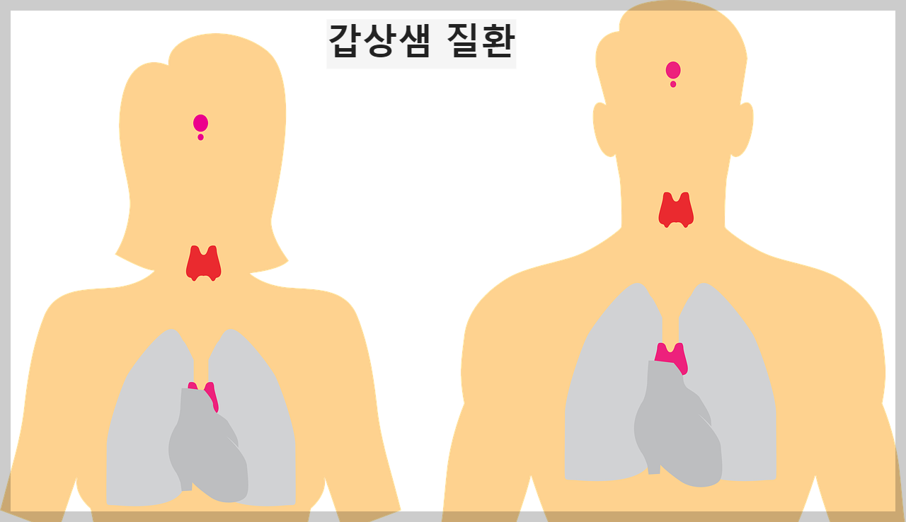 갑상샘진환