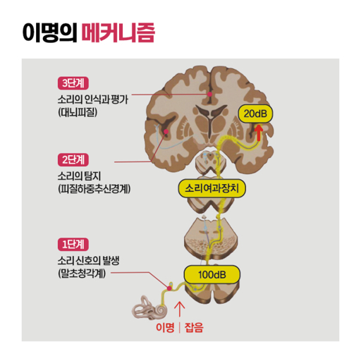 이명증 치료 방법과 효과