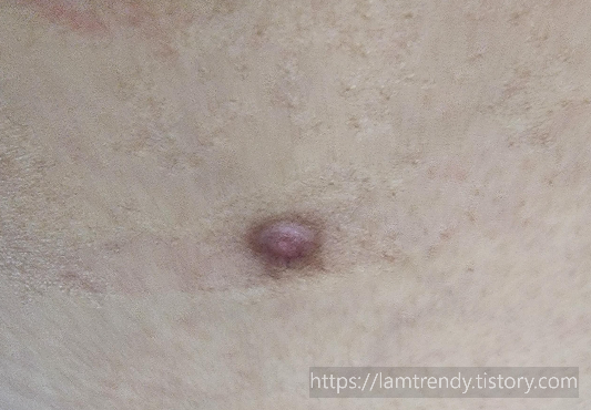 쥐젖 내동치료 5일차