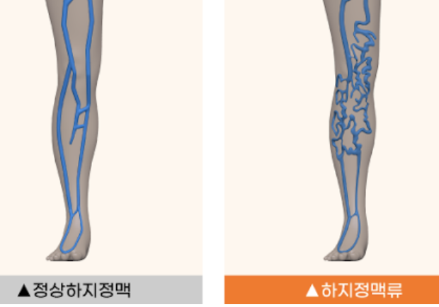 하지 정맥류 증상 1