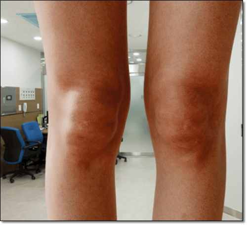 무릎연골 손상으로 인한 관절염 환자