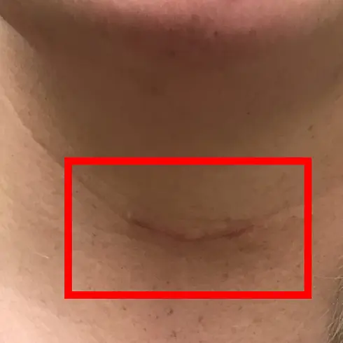 갑상선암 절개 수술 흉터와 로봇수술 흉터 비교-1