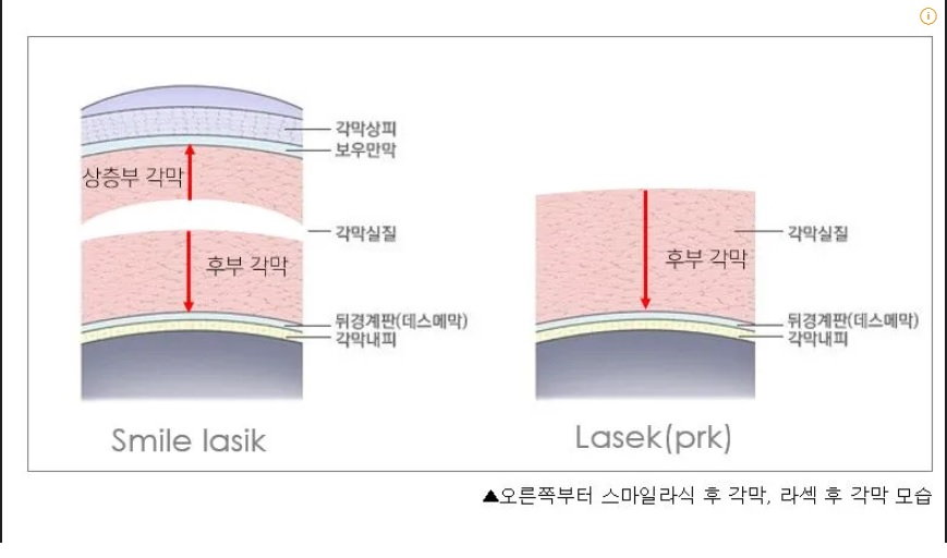 스마일 라식 후 모습