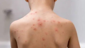 피부 붉은반점 18