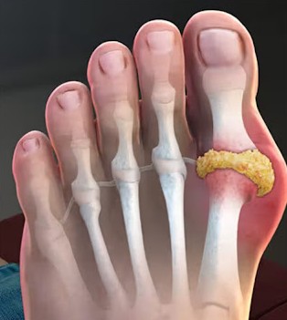 통풍에 좋은 음식과 나쁜 음식