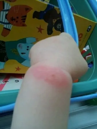 모기 물려 가려울 때 땀띠에 안티푸라민 연고 효능 부작용 사용후기_15