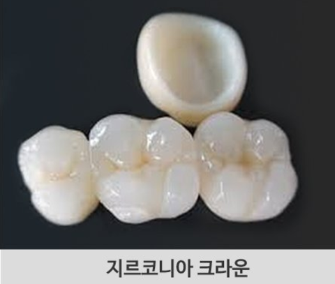 미니 임플란트