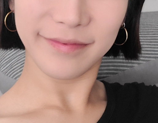 인중 축소 수술 후기