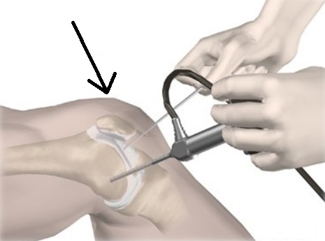 무릎연골-봉합술