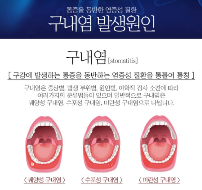 구내염 원인