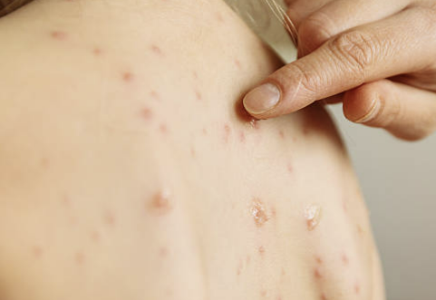 대상포진 예방접종 가격(최저가) 초기증상 치료방법 총정리