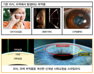스마일라식
