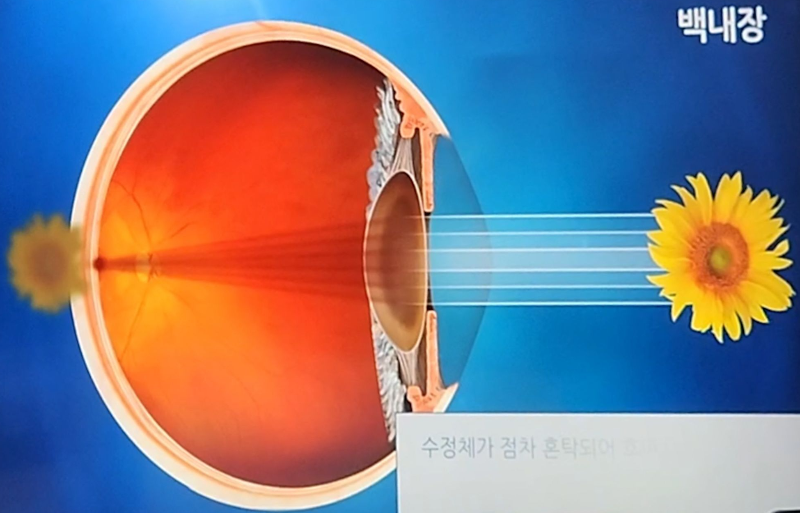 백내장
