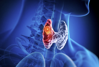 갑상선에 암이 생긴 그림