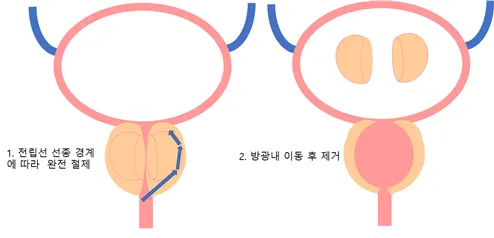 전립선비대증 치료