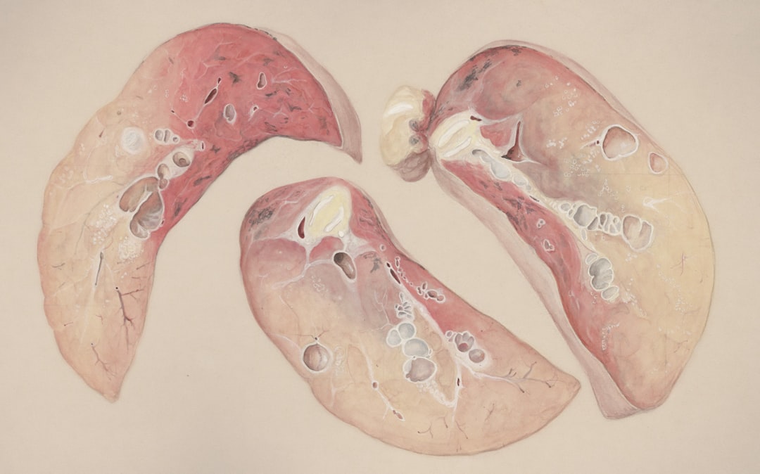 gastritis