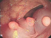 젊은층까지 확산되는 대장암