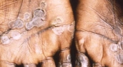 원숭이두창 이미지