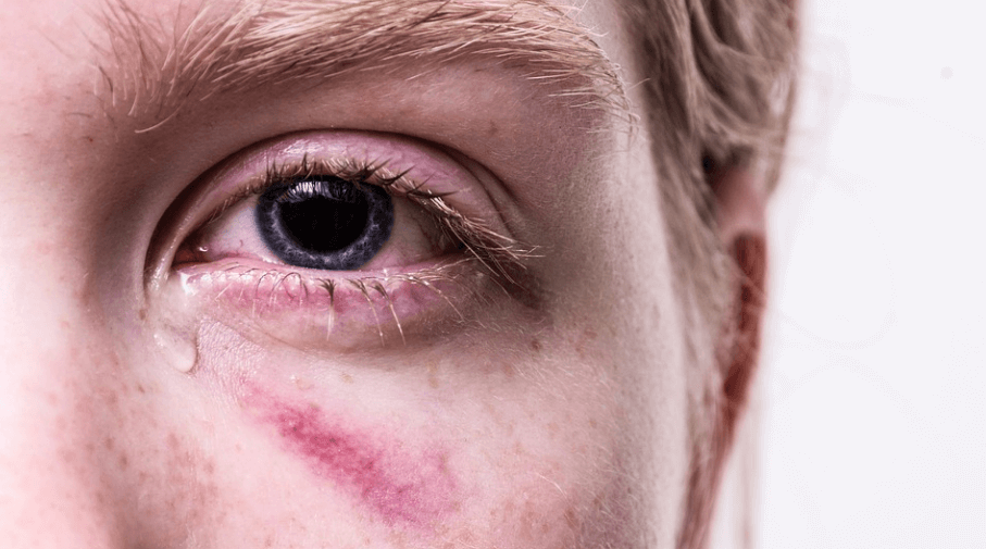 눈밑에 상처로 눈물을 흘리고 있다