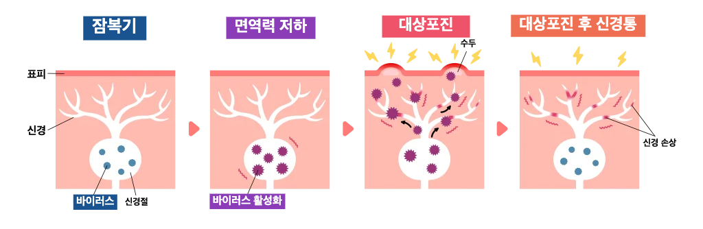 대상포진 초기증상