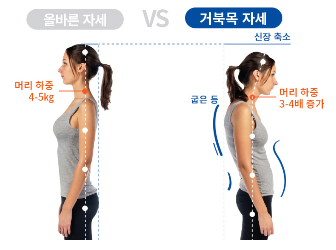 거북목 증후군 관련 사진