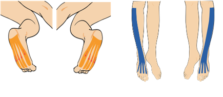 냉증 완화를 위한 근육 테이핑요법