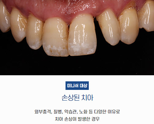 손상된 치아