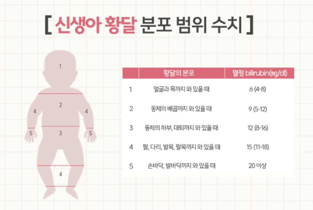 신생아 황달