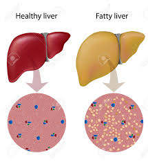지방간 없애는 방법