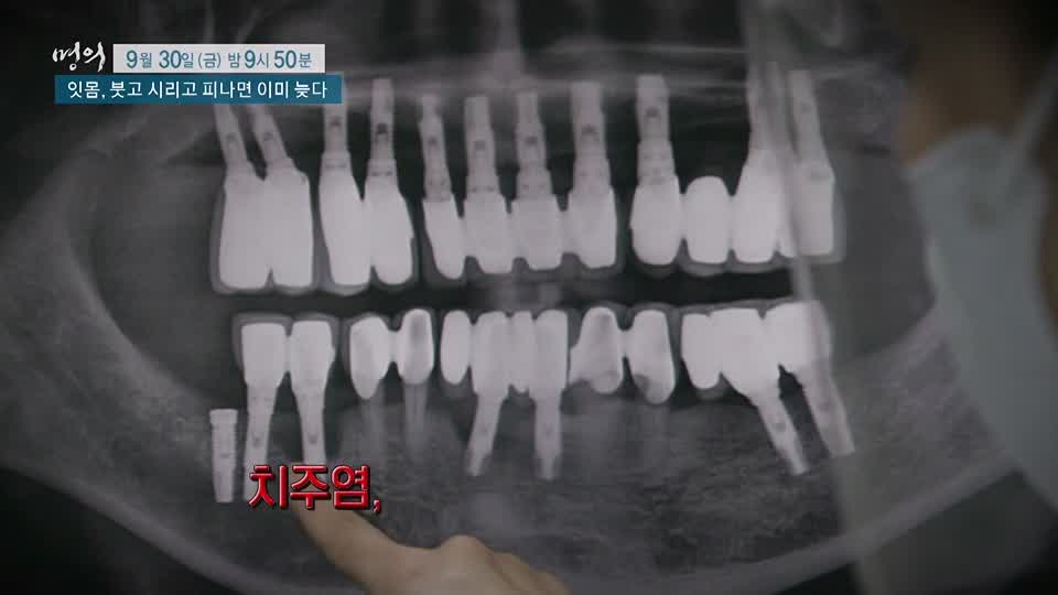 명의 붓고, 시리고, 피나면 이미 늦는 치주염 잇몸 질환 치주질환 치료, 예방 방법