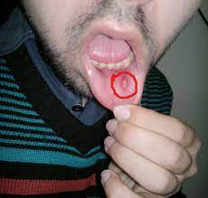 구내염 식이요법