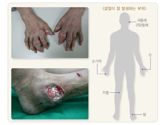 만성통풍의 결절 및 궤양 (출처:국가건강정보포털)