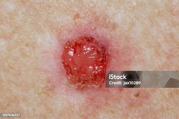 기저세포암 관련 사진