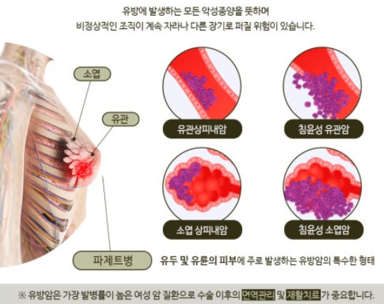 유방암 생존자와 알츠하이머병: 생존 후 뇌 건강 관련 이미지