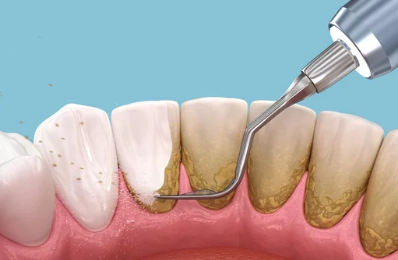 치석 사진/출처:어도비스톡
