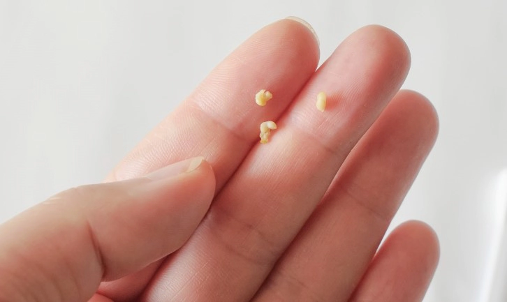 편도결석 빼는법