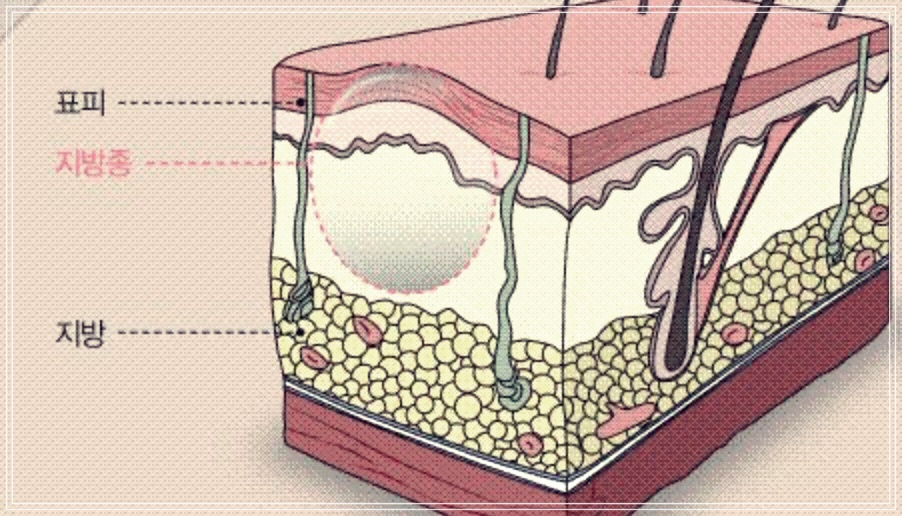 얼굴 지방종 제거 방법