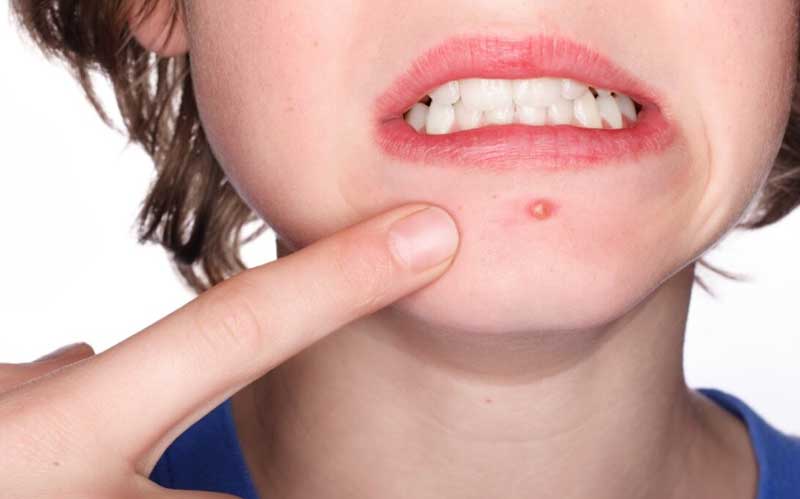 기미의 원인 염증 후 색소 침착