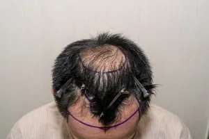 모발이식-4000모-비용