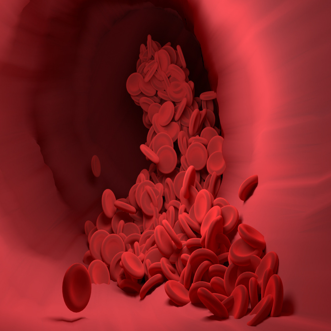 50대 이상 필독! 다발성 골수종 전조 증상