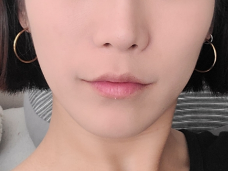 인중 축소 수술 후기