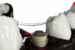 오산시-임플란트-치과-가격-비용-싼-곳,저렴한-곳,잘하는-곳,유명한-곳-BEST20-추천7