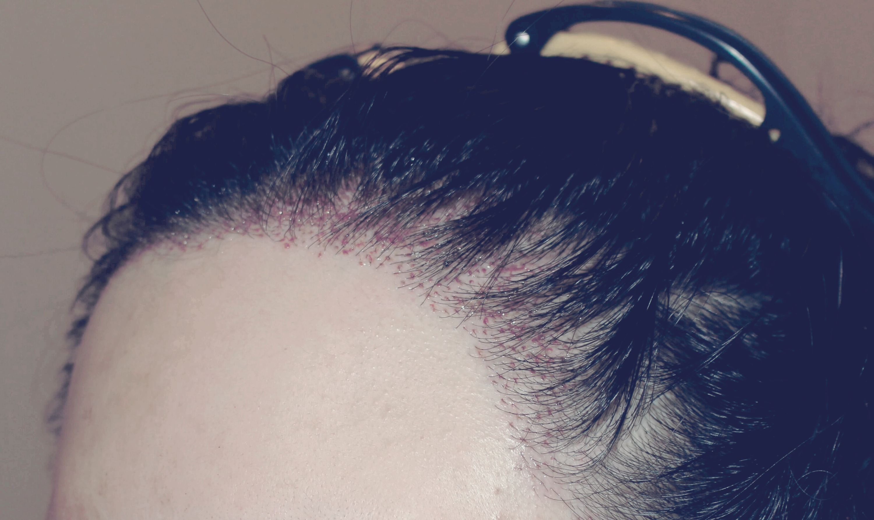 2차 보강 수술 좌측