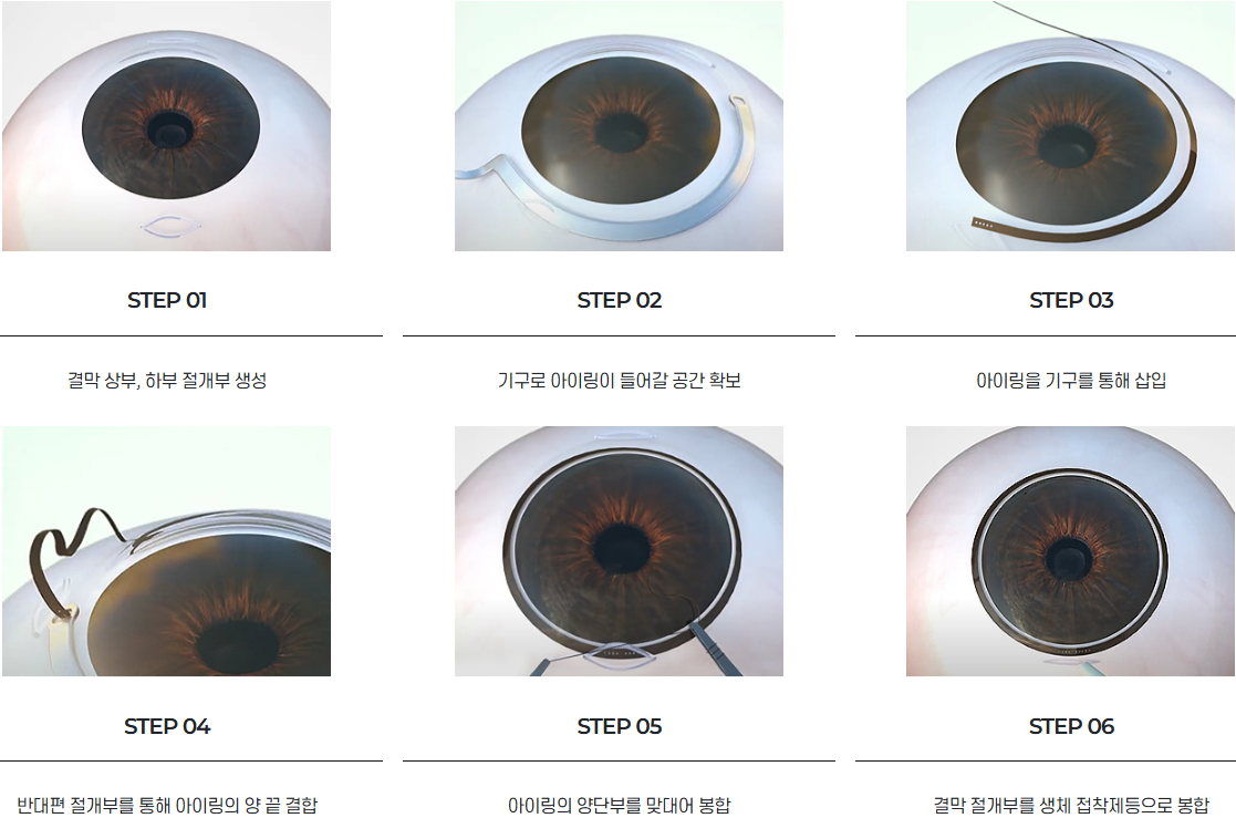 아이링 수술, 눈동자 성형, 아이링 수술 가격, 아이링 수술 부작용, 아이링 수술 후기, 아이링 수술 전후 사진, 아이링 수술 회복 기간, 서클렌즈 대체 성형, 눈동자 확대 수술