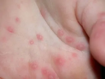 수족구병 증상과 예방 조치 방법 모음_4