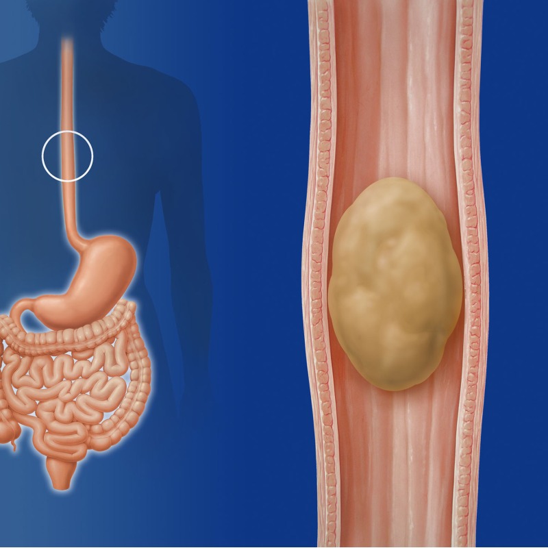 가래가 생기는 원인