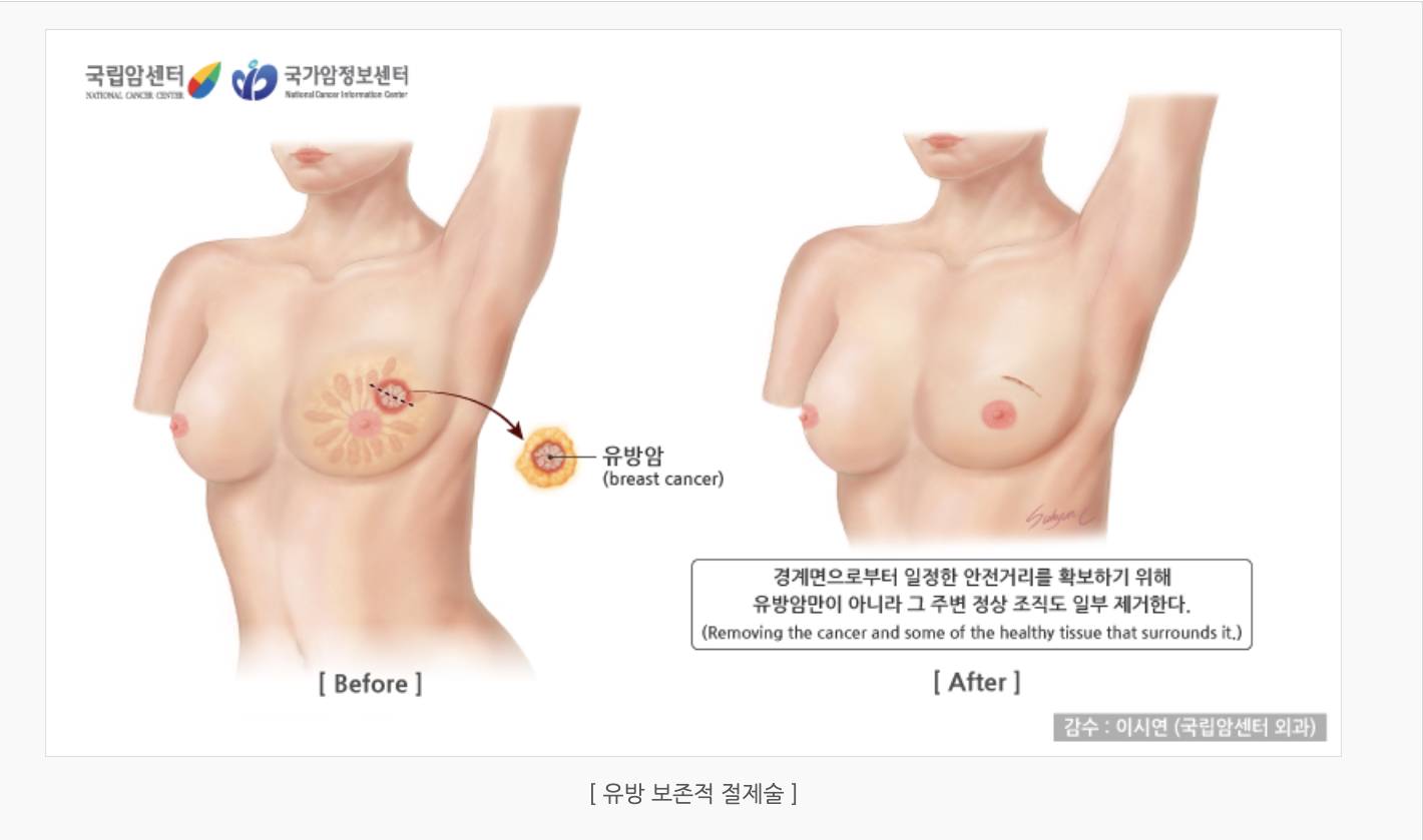 유방 보존적 절제술