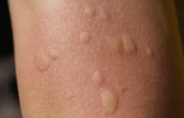 피부 붉은반점 9