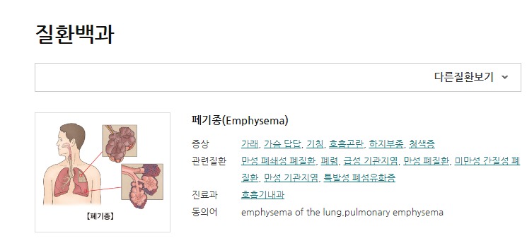 폐기종(서울아산병원홈페이지)